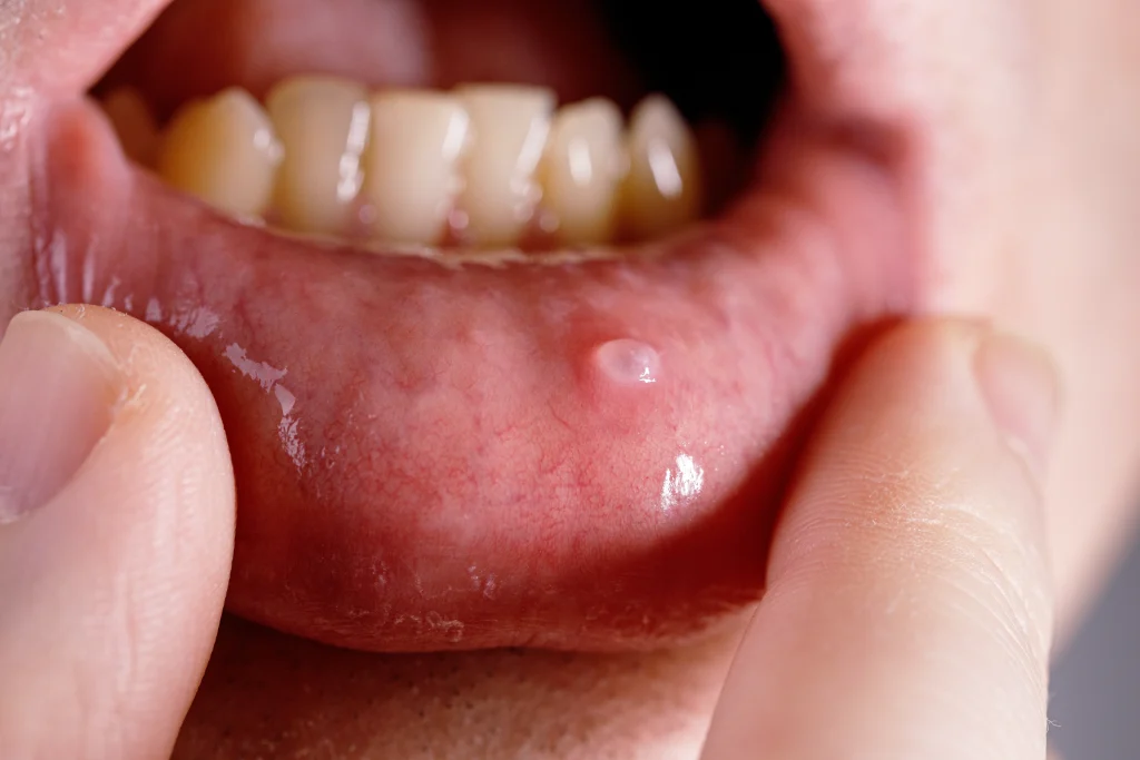 Mucocele orale: cos’è, da cosa dipende e come si cura