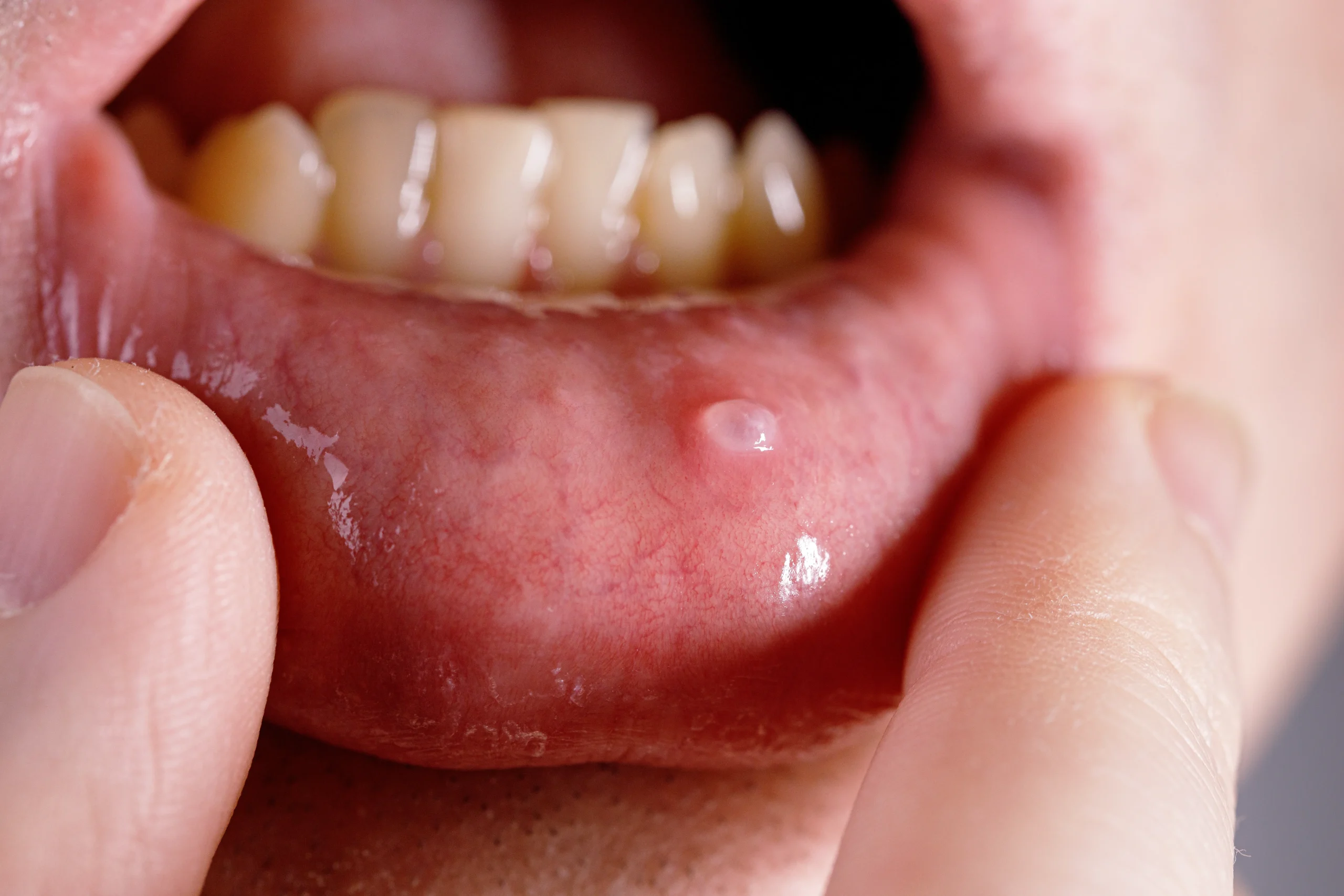 Mucocele orale: quella piccola bolla che non va ignorata