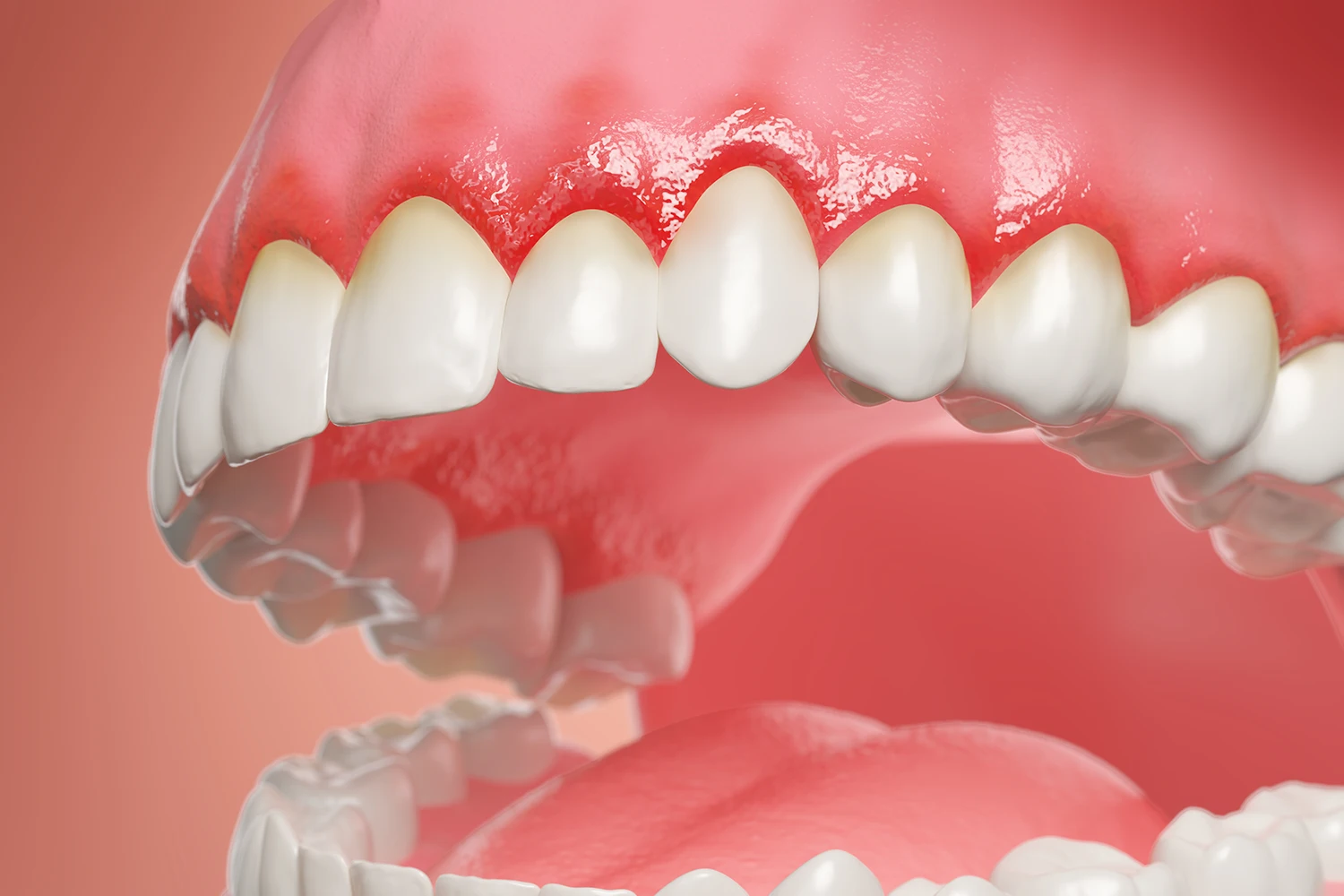 Infezione gengivale: cause, sintomi e rimedi efficaci a Milano