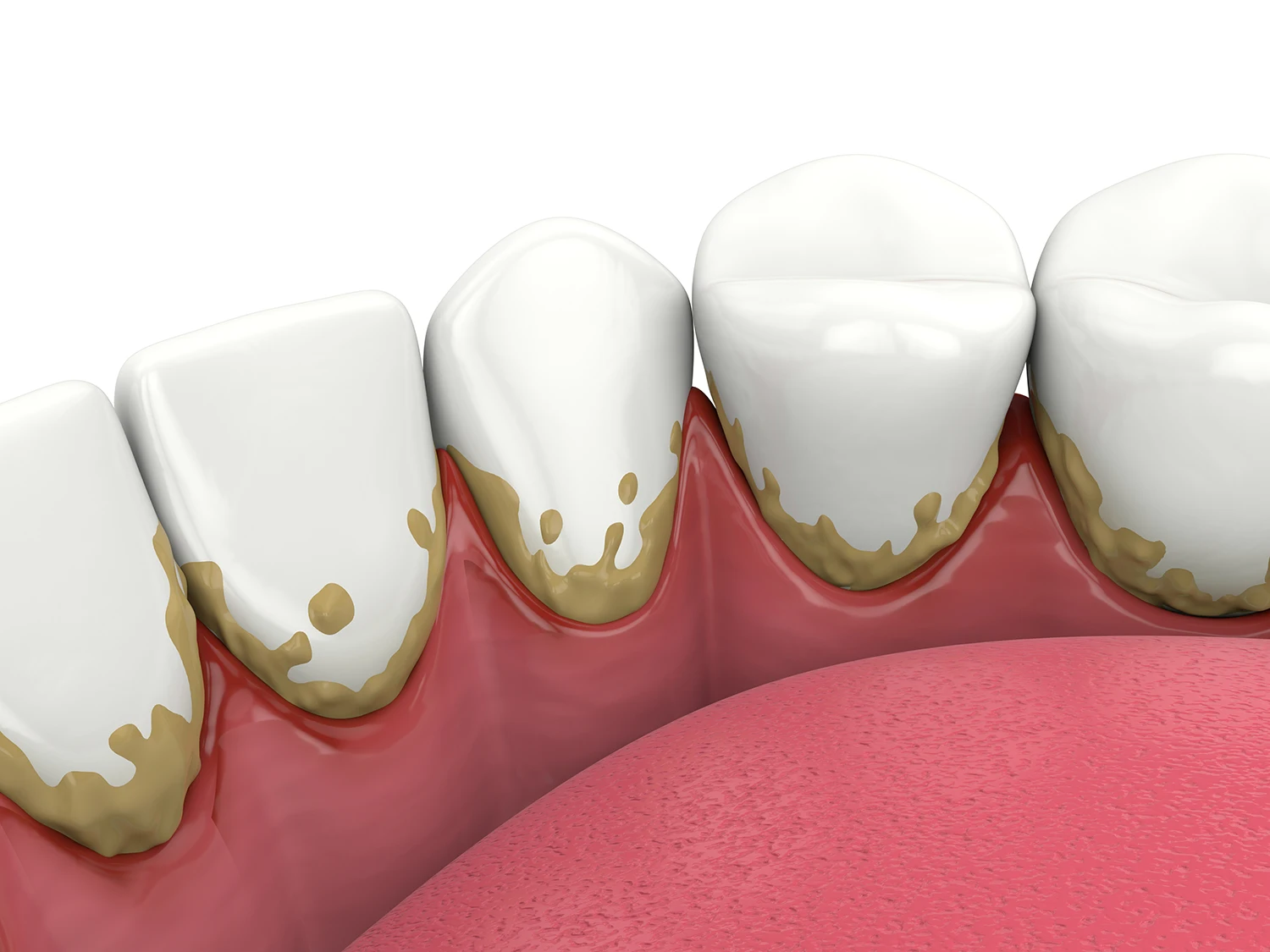 Tartaro ai denti: come eliminarlo e mantenere una pulizia efficace